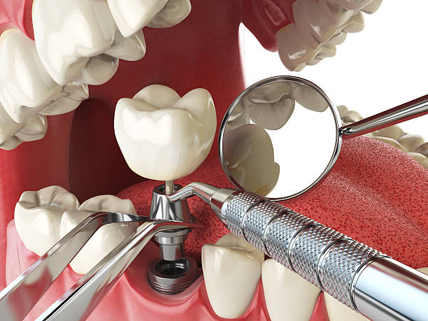Best Emergency Denture Repair in White Rock, NM
